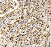 IHC staining of FFPE human appendix adenocarcinoma tissue with JUND antibody. HIER: boil tissue sections in pH8 EDTA for 20 min and allow to cool before testing.
