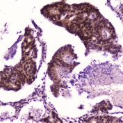 IHC testing of FFPE human colon cancer with p65 antibody at 2ug/ml. HIER: boil tissue sections in pH6, 10mM citrate buffer, for 10-20 min followed by cooling at RT for 20 min.