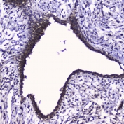 IHC testing of FFPE human breast cancer with Ckk6 antibody at 2ug/ml. HIER: boil tissue sections in pH6, 10mM citrate buffer, for 10-20 min followed by cooling at RT for 20 min.