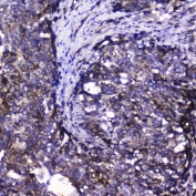 IHC testing of FFPE human intestinal cancer with Ckk6 antibody at 2ug/ml. HIER: boil tissue sections in pH6, 10mM citrate buffer, for 10-20 min followed by cooling at RT for 20 min.