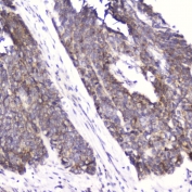 IHC testing of FFPE human esophageal squamous cell carcinoma with FABP3 antibody at 2ug/ml. HIER: boil tissue sections in pH6, 10mM citrate buffer, for 10-20 min followed by cooling at RT for 20 min.
