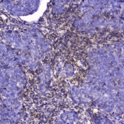 IHC testing of FFPE human lung cancer with Talin 1 antibody at 2ug/ml. HIER: boil tissue sections in pH6, 10mM citrate buffer, for 10-20 min followed by cooling at RT for 20 min.
