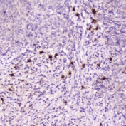 IHC testing of FFPE human sarcoma with Ribonuclease 3 antibody at 2ug/ml. HIER: boil tissue sections in pH6, 10mM citrate buffer, for 10-20 min followed by cooling at RT for 20 min.