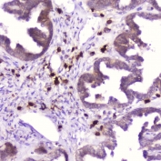 IHC testing of FFPE human ovarian cancer with Ribonuclease 3 antibody at 2ug/ml. HIER: boil tissue sections in pH6, 10mM citrate buffer, for 10-20 min followed by cooling at RT for 20 min.