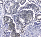 IHC staining of FFPE human intestinal cancer with HSP105 antibody at 1ug/ml. HIER: boil tissue sections in pH6, 10mM citrate buffer, for 10-20 min and allow to cool before testing.