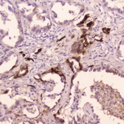 IHC testing of FFPE human lung cancer with Cathepsin E antibody at 2ug/ml. HIER: boil tissue sections in pH6, 10mM citrate buffer, for 10-20 min followed by cooling at RT for 20 min.