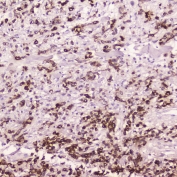 IHC testing of FFPE human gastric cancer with Cathepsin E antibody at 2ug/ml. HIER: boil tissue sections in pH6, 10mM citrate buffer, for 10-20 min followed by cooling at RT for 20 min.