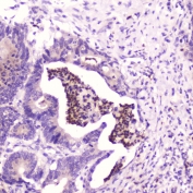 IHC testing of FFPE human colon cancer with SPARCL1 antibody at 2ug/ml. HIER: boil tissue sections in pH6, 10mM citrate buffer, for 10-20 min followed by cooling at RT for 20 min.