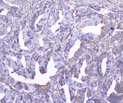 IHC testing of FFPE human colon cancer with GSTM1 antibody at 2ug/ml. HIER: boil tissue sections in pH6, 10mM citrate buffer, for 10-20 min followed by cooling at RT for 20 min.