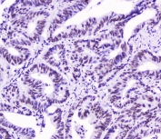 IHC testing of FFPE human intestinal cancer with SMC3 antibody at 2ug/ml. HIER: boil tissue sections in pH6, 10mM citrate buffer, for 10-20 min followed by cooling at RT for 20 min.