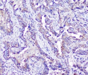 IHC staining of FFPE human lung cancer with ARSA antibody. HIER: boil tissue sections in pH6, 10mM citrate buffer, for 20 min and allow to cool before testing.