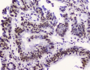 IHC testing of FFPE human intestinal cancer with RbAp48 antibody. HIER: boil tissue sections in pH6, 10mM citrate buffer, for 10-20 min followed by cooling at RT for 20 min.
