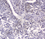 IHC testing of FFPE human lung cancer with HSPA2 antibody at 2ug/ml. HIER: boil tissue sections in pH6, 10mM citrate buffer, for 10-20 min followed by cooling at RT for 20 min.