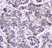 IHC testing of FFPE human breast cancer with Cytochrome C antibody at 2ug/ml. HIER: boil tissue sections in pH6, 10mM citrate buffer, for 10-20 min followed by cooling at RT for 20 min.