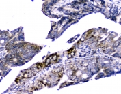 IHC testing of FFPE human intestinal cancer with Cytochrome C antibody at 2ug/ml. HIER: boil tissue sections in pH6, 10mM citrate buffer, for 10-20 min followed by cooling at RT for 20 min.