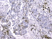 IHC testing of FFPE human lung cancer with Cytochrome C antibody at 2ug/ml. HIER: boil tissue sections in pH6, 10mM citrate buffer, for 10-20 min followed by cooling at RT for 20 min.