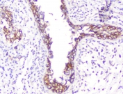 IHC testing of FFPE human breast cancer with Beta Catenin antibody. HIER: boil tissue sections in pH6, 10mM citrate buffer, for 10-20 min followed by cooling at RT for 20 min.