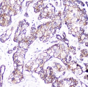 IHC testing of FFPE human breast cancer with Beta Catenin antibody. HIER: boil tissue sections in pH6, 10mM citrate buffer, for 10-20 min followed by cooling at RT for 20 min.