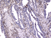 IHC testing of FFPE human rectal cancer with ITGB2 antibody at 2ug/ml. HIER: boil tissue sections in pH6, 10mM citrate buffer, for 10-20 min followed by cooling at RT for 20 min.