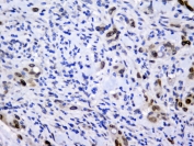 IHC testing of FFPE human rectal cancer with Emerin antibody at 2ug/ml. HIER: boil tissue sections in pH6, 10mM citrate buffer, for 10-20 min followed by cooling at RT for 20 min.