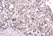 IHC testing of FFPE human gastric cancer with Emerin antibody at 2ug/ml. HIER: boil tissue sections in pH6, 10mM citrate buffer, for 10-20 min followed by cooling at RT for 20 min.