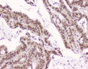 IHC testing of FFPE human intestinal cancer with XPO1 antibody at 2ug/ml. HIER: boil tissue sections in pH6, 10mM citrate buffer, for 10-20 min followed by cooling at RT for 20 min.