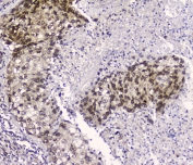 IHC testing of FFPE human lung cancer with XPO1 antibody at 2ug/ml. HIER: boil tissue sections in pH6, 10mM citrate buffer, for 10-20 min followed by cooling at RT for 20 min.