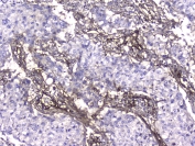 IHC testing of FFPE human lung cancer with Collagen IV antibody at 2ug/ml. HIER: boil tissue sections in pH6, 10mM citrate buffer, for 10-20 min followed by cooling at RT for 20 min.