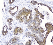 IHC testing of FFPE human intestinal cancer with Cytokeratin 19 antibody at 1ug/ml. HIER: boil tissue sections in pH6, 10mM citrate buffer, for 10-20 min followed by cooling at RT for 20 min.