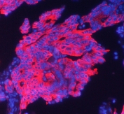 Immunofluorescent staining of human intestinal cancer with Cytokeratin 19 antibody at 1ug/ml. HIER: boil tissue sections in pH6, 10mM citrate buffer, for 10-20 min followed by cooling at RT for 20 min.