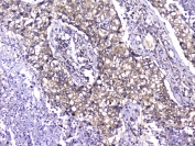 IHC testing of FFPE human lung cancer with TCP1 alpha antibody at 2ug/ml. HIER: boil tissue sections in pH6, 10mM citrate buffer, for 10-20 min followed by cooling at RT for 20 min.