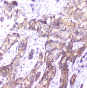 IHC testing of FFPE human breast cancer with SMN1/2 antibody. HIER: boil tissue sections in pH6, 10mM citrate buffer, for 10-20 min followed by cooling at RT for 20 min.