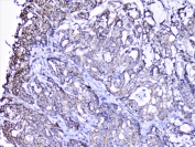IHC staining of FFPE human gastric carcinoma with Cortactin antibody at 1ug/ml. HIER: boil tissue sections in pH6, 10mM citrate buffer, for 10-20 min followed by cooling at RT for 20 min.