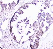 IHC staining of FFPE human ovarian carcinoma with Cortactin antibody at 1ug/ml. HIER: boil tissue sections in pH6, 10mM citrate buffer, for 10-20 min followed by cooling at RT for 20 min.
