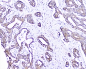 IHC staining of FFPE human cholangiocarcinoma carcinoma with Cortactin antibody at 1ug/ml. HIER: boil tissue sections in pH6, 10mM citrate buffer, for 10-20 min followed by cooling at RT for 20 min.
