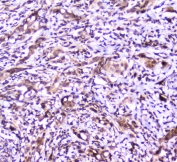 IHC staining of FFPE human intestinal cancer with SP1 antibody at 1ug/ml. HIER: boil tissue sections in pH6, 10mM citrate buffer, for 10-20 min followed by cooling at RT for 20 min.