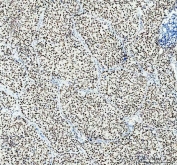 IHC staining of FFPE human intestinal cancer with SP1 antibody at 1ug/ml. HIER: boil tissue sections in pH6, 10mM citrate buffer, for 10-20 min followed by cooling at RT for 20 min.