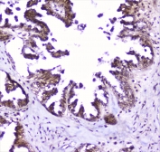 IHC staining of FFPE human ovarian cancer with SP1 antibody at 1ug/ml. HIER: boil tissue sections in pH6, 10mM citrate buffer, for 10-20 min followed by cooling at RT for 20 min.
