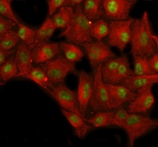 IHC staining of FFPE human ovarian cancer with SP1 antibody at 1ug/ml. HIER: boil tissue sections in pH6, 10mM citrate buffer, for 10-20 min followed by cooling at RT for 20 min.