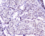 IHC staining of FFPE human lung cancer with SP1 antibody at 1ug/ml. HIER: boil tissue sections in pH6, 10mM citrate buffer, for 10-20 min followed by cooling at RT for 20 min.