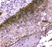 IHC staining of FFPE human esophagus squama cancer with TMEM16A antibody. HIER: boil tissue sections in pH6, 10mM citrate buffer, for 20 min and allow to cool before testing.