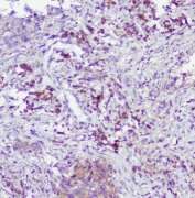 IHC staining of FFPE human lung cancer with Caspase-2 antibody at 0.5ug/ml. HIER: boil tissue sections in pH6, 10mM citrate buffer, for 10-20 min followed by cooling at RT for 20 min.
