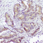 IHC staining of FFPE human colon cancer with Caspase-2 antibody at 0.5ug/ml. HIER: boil tissue sections in pH6, 10mM citrate buffer, for 10-20 min followed by cooling at RT for 20 min.
