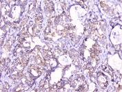 IHC staining of FFPE human stomach cancer with COMP antibody at 1ug/ml. HIER: boil tissue sections in pH6, 10mM citrate buffer, for 10-20 min followed by cooling at RT for 20 min.