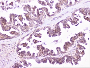IHC staining of FFPE human ovarian cancer with COMP antibody at 1ug/ml. HIER: boil tissue sections in pH6, 10mM citrate buffer, for 10-20 min followed by cooling at RT for 20 min.