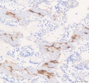 IHC staining of FFPE human ovarian cancer with COMP antibody at 1ug/ml. HIER: boil tissue sections in pH6, 10mM citrate buffer, for 10-20 min followed by cooling at RT for 20 min.