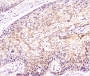 IHC staining of FFPE human esophagus squama cancer with COMP antibody at 1ug/ml. HIER: boil tissue sections in pH6, 10mM citrate buffer, for 10-20 min followed by cooling at RT for 20 min.