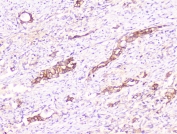 IHC staining of FFPE human intestinal cancer with COMP antibody at 1ug/ml. HIER: boil tissue sections in pH6, 10mM citrate buffer, for 10-20 min followed by cooling at RT for 20 min.