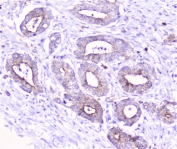 IHC staining of FFPE human cholangiocarcinoma cancer with COMP antibody at 1ug/ml. HIER: boil tissue sections in pH6, 10mM citrate buffer, for 10-20 min followed by cooling at RT for 20 min.