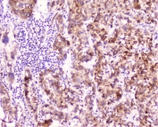 IHC staining of FFPE human liver cancer with C Reactive Protein antibody at 1ug/ml. HIER: boil tissue sections in pH6, 10mM citrate buffer, for 10-20 min followed by cooling at RT for 20 min.